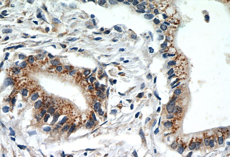 Immunohistochemistry of paraffin-embedded human pancreas cancer slide using Catalog No:107250(EEF1D Antibody) at dilution of 1:50