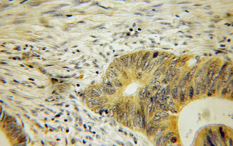 Immunohistochemical of paraffin-embedded human colon cancer using Catalog No:109364(COASY antibody) at dilution of 1:100 (under 10x lens)