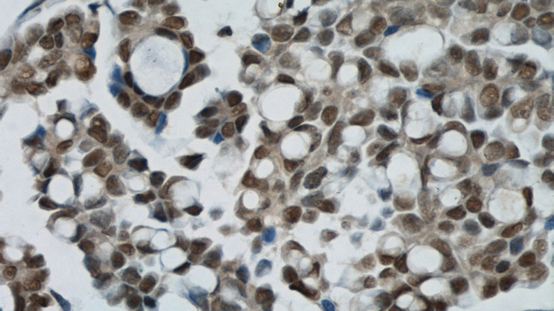 Immunohistochemical of paraffin-embedded human ovary tumor using Catalog No:116649(ubiquitin antibody) at dilution of 1:50 (under 40x lens)