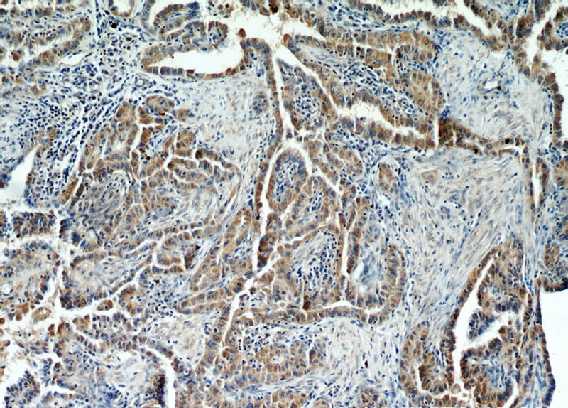 Immunohistochemical of paraffin-embedded human thyroid cancer using Catalog No:111345(HIF1A antibody) at dilution of 1:50 (under 10x lens)