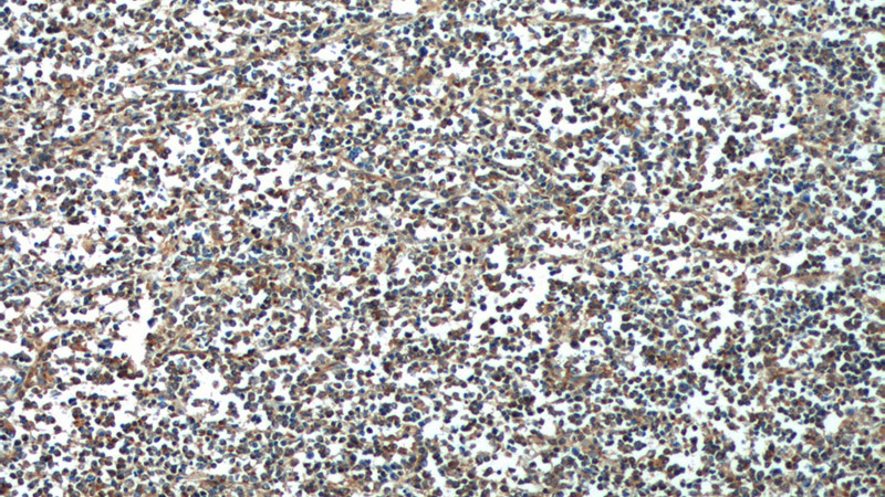 Immunohistochemistry of paraffin-embedded human lymphoma tissue slide using Catalog No:108364(BAX Antibody) at dilution of 1:200 (under 10x lens).