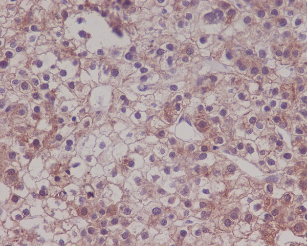 Immunohistochemical analysis of paraffin-embedded human liver carcinoma, using LRP1 Antibody.