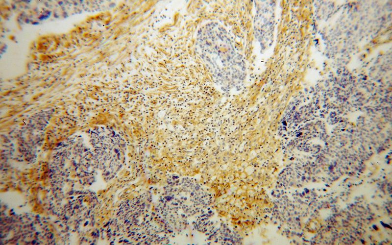 Immunohistochemical of paraffin-embedded human ovary tumor using Catalog No:111546(HSD17B2 antibody) at dilution of 1:100 (under 10x lens)