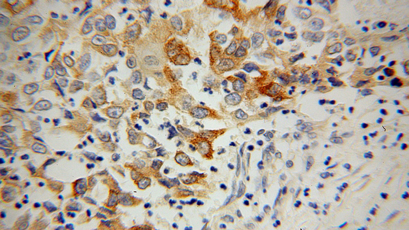 Immunohistochemical of paraffin-embedded human pancreas cancer using Catalog No:110310(EEF1A1 antibody) at dilution of 1:100 (under 40x lens)