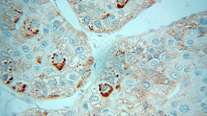 Immunohistochemical of paraffin-embedded human liver cancer using Catalog No:116906(ZBP1 antibody) at dilution of 1:50 (under 40x lens)