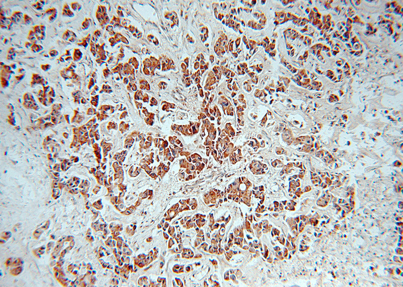 Immunohistochemical of paraffin-embedded human breast cancer using Catalog No:116020(TGFB2-Specific antibody) at dilution of 1:100 (under 10x lens)