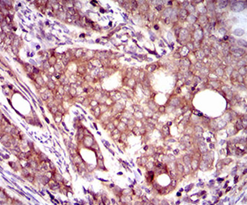 Fig5: Immunohistochemical analysis of paraffin-embedded human cervical cancer tissue using anti-DCTN4 antibody. Counter stained with hematoxylin.