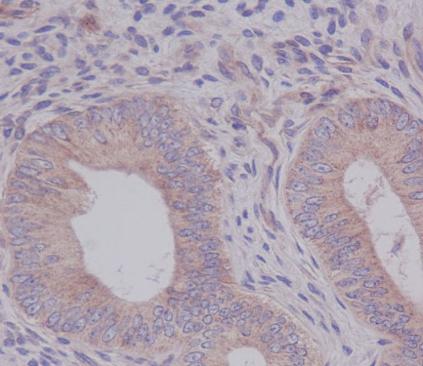 Immunohistochemical analysis of paraffin-embedded human uterus cancer, using eIF5A Antibody.
