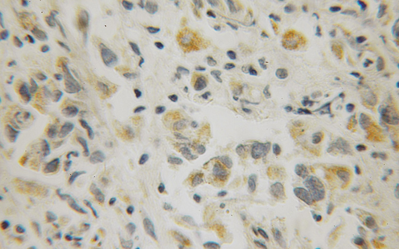 Immunohistochemical of paraffin-embedded human prostate cancer using Catalog No:114404(RAB10 antibody) at dilution of 1:100 (under 10x lens)