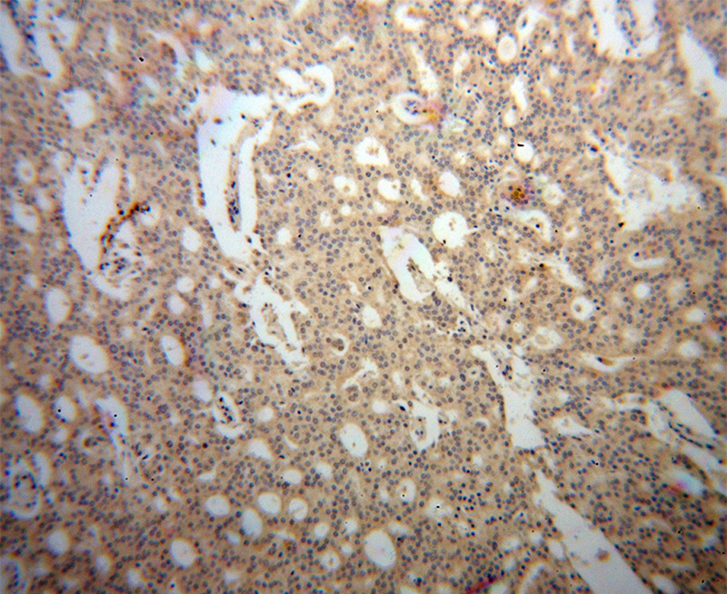 Immunohistochemical of paraffin-embedded human prostate cancer using Catalog No:108250(ARFGAP1 antibody) at dilution of 1:100 (under 10x lens)