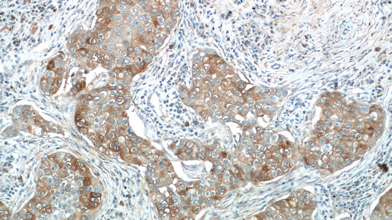 Immunohistochemistry of paraffin-embedded human breast cancer tissue slide using Catalog No:116198(TMEM87A Antibody) at dilution of 1:50 (under 10x lens)