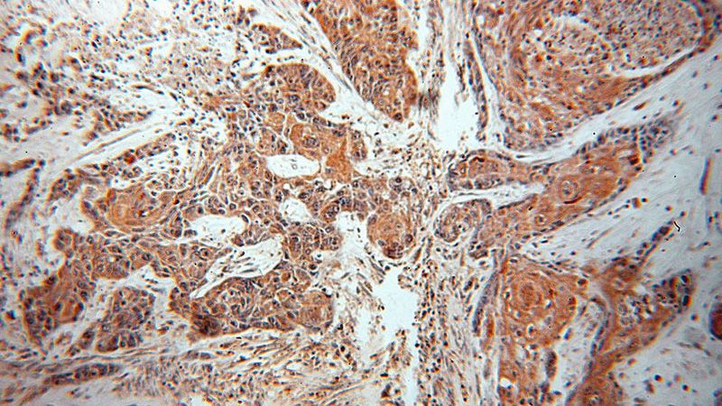 Immunohistochemical of paraffin-embedded human oesophagus cancer using Catalog No:113148(NEFH antibody) at dilution of 1:50 (under 10x lens)