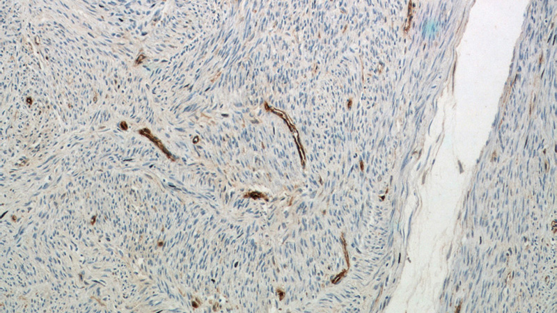 Immunohistochemical of paraffin-embedded human hysteromyoma using Catalog No:109030(CD34 antibody) at dilution of 1:50 (under 10x lens)