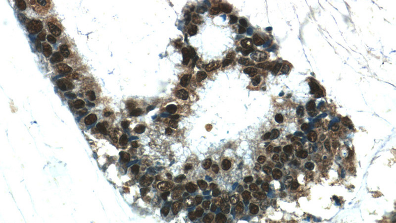 Immunohistochemistry of paraffin-embedded human colon cancer tissue slide using Catalog No:110618(FEN1 Antibody) at dilution of 1:50 (under 40x lens)