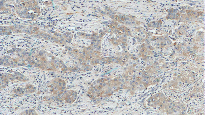 Immunohistochemistry of paraffin-embedded human breast cancer tissue slide using Catalog No:112010(KIF2A Antibody) at dilution of 1:200 (under 10x lens).