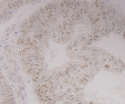 Fig4: Immunohistochemical analysis of paraffin-embedded human endometrial cancer tissue using anti-GRAMD1A antibody. Counter stained with hematoxylin.