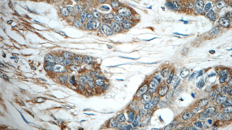 Immunohistochemistry of paraffin-embedded human skin cancer tissue slide using Catalog No:111621(IFIT5 Antibody) at dilution of 1:50 (under 40x lens)
