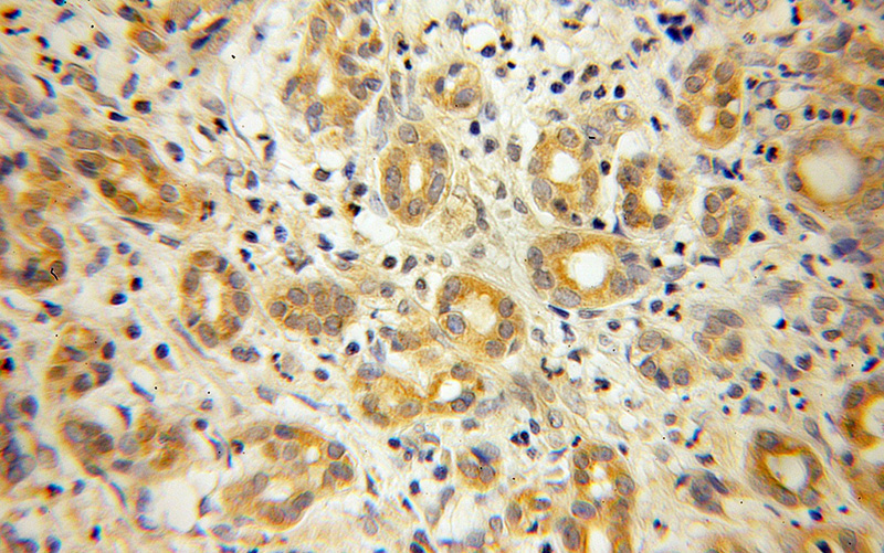 Immunohistochemical of paraffin-embedded human pancreas cancer using Catalog No:110095(DNAJB4 antibody) at dilution of 1:100 (under 40x lens)