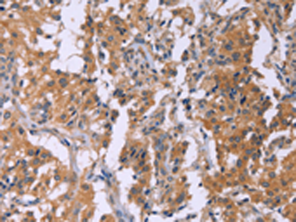 The image is immunohistochemistry of paraffin-embedded Human thyroid cancer tissue using 166797(CMTM6 Antibody) at dilution 1/40, on the right is treated with synthetic peptide. (Original magnification: ×200)