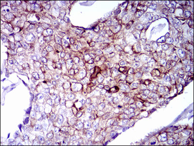 Immunohistochemical analysis of paraffin-embedded breast cancer tissues using CK5 mouse mAb with DAB staining.