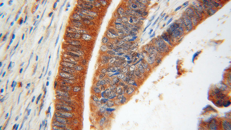 Immunohistochemical of paraffin-embedded human colon cancer using Catalog No:115253(SKAP2 antibody) at dilution of 1:100 (under 40x lens)
