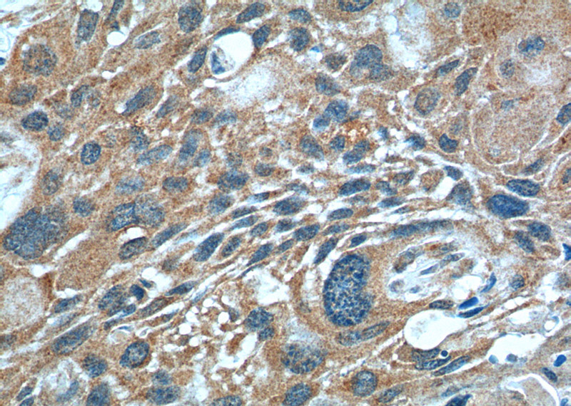 Immunohistochemistry of paraffin-embedded human oesophagus cancer tissue slide using Catalog No:116736(KDR Antibody) at dilution of 1:200 (under 40x lens).