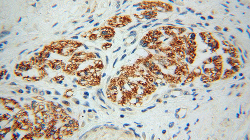 Immunohistochemical of paraffin-embedded human colon cancer using Catalog No:110021(DRG2 antibody) at dilution of 1:100 (under 40x lens)