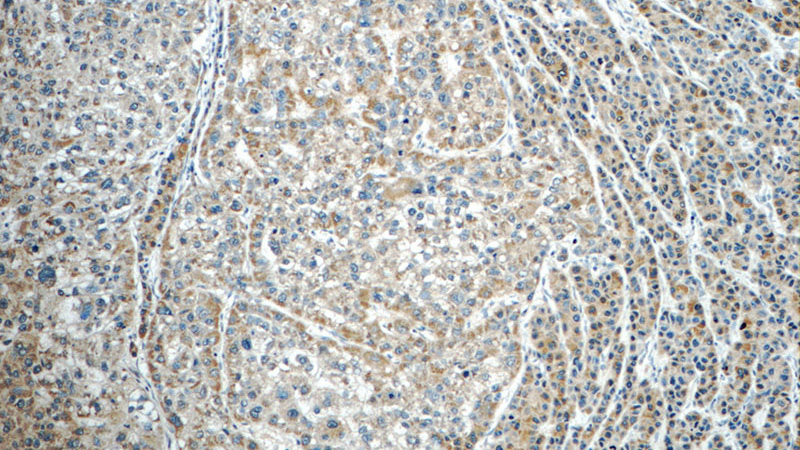 Immunohistochemistry of paraffin-embedded human liver cancer tissue slide using Catalog No:108644(C11orf74 Antibody) at dilution of 1:50 (under 10x lens)