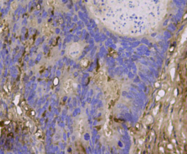 Fig3: Immunohistochemical analysis of paraffin- embedded human colon cancer tissue using anti-BMP11 rabbit polyclonal antibody.