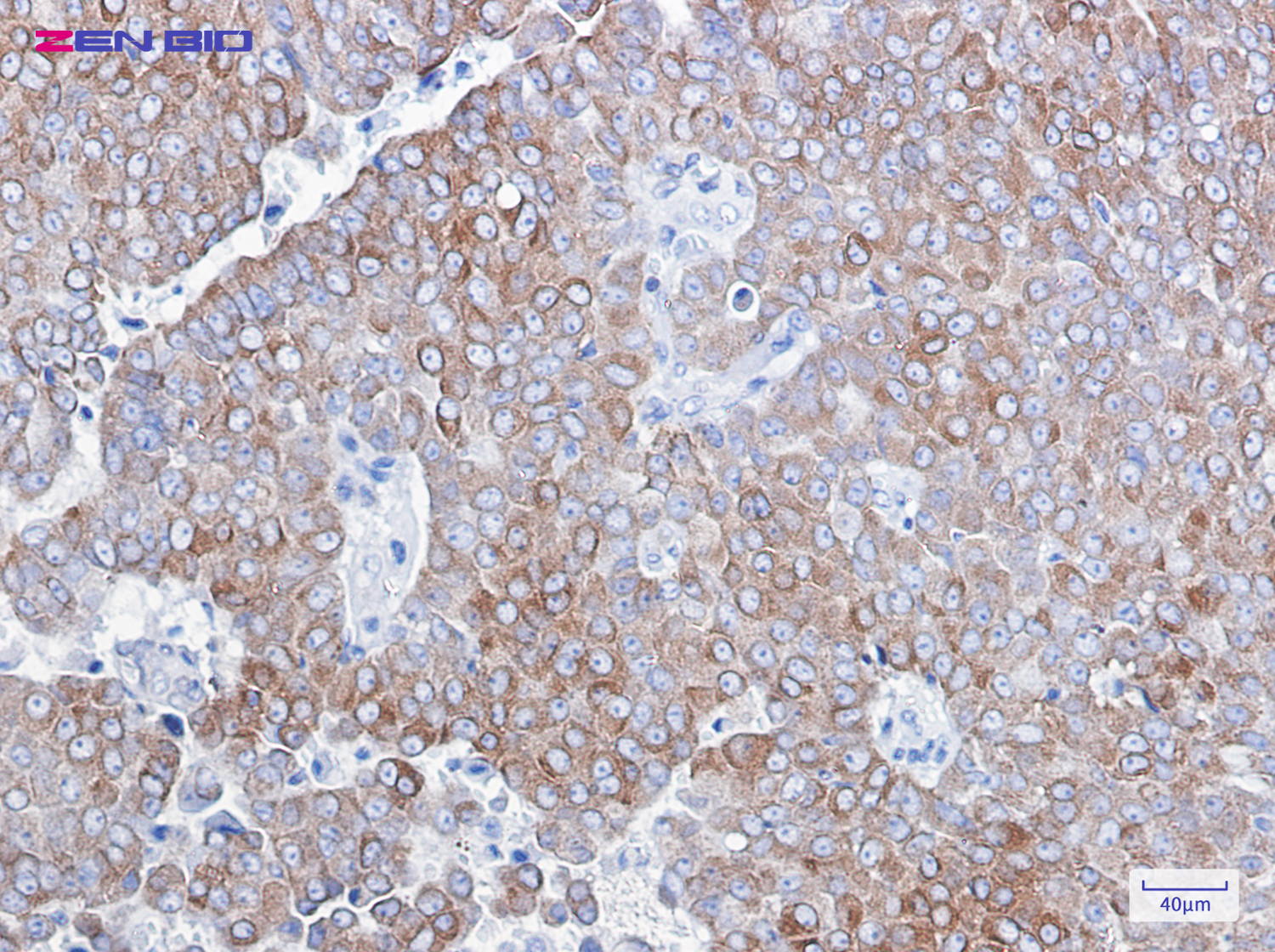 Immunohistochemistry of Bcl-2 in paraffin-embedded Human breast cancer tissue using Bcl-2 Rabbit pAb at dilution 1/100