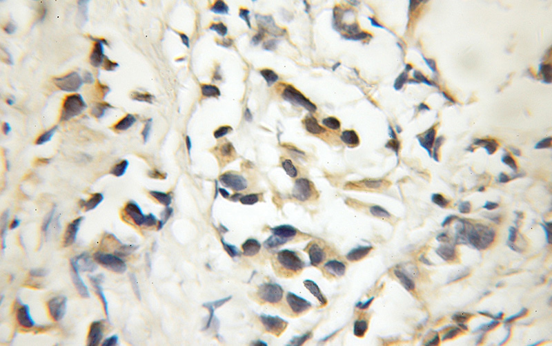 Immunohistochemical of paraffin-embedded human prostate cancer using Catalog No:109911(DGKE antibody) at dilution of 1:50 (under 10x lens)