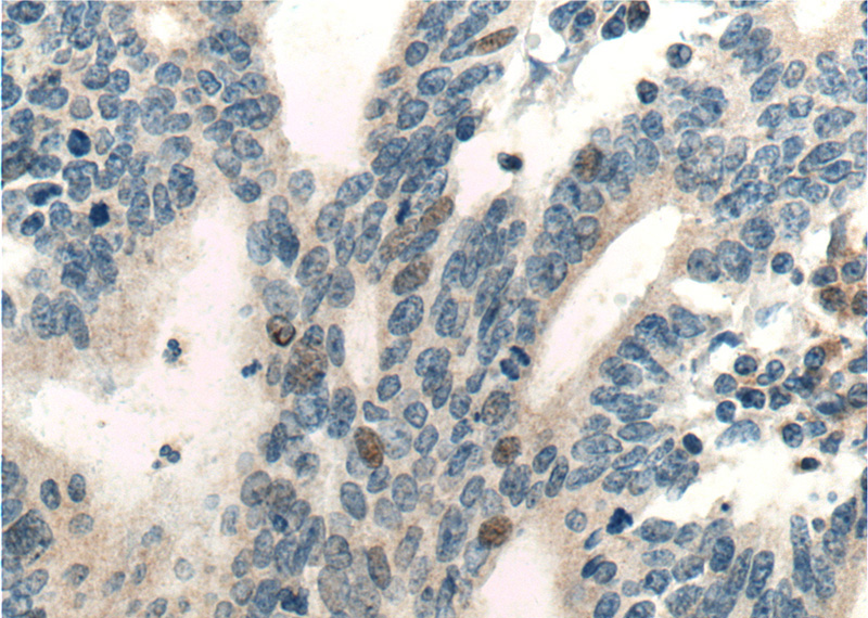 Immunohistochemistry of paraffin-embedded human endometrial cancer tissue slide using Catalog No:114758(RNF38 Antibody) at dilution of 1:200 (under 40x lens). heat mediated antigen retrieved with Tris-EDTA buffer(pH9).