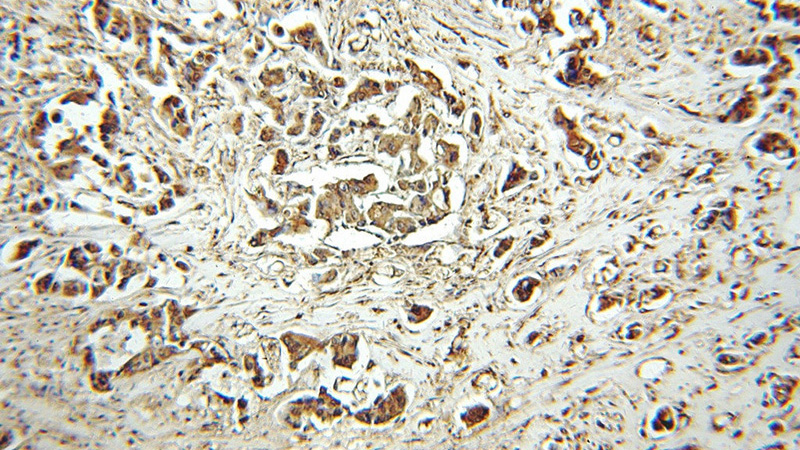 Immunohistochemical of paraffin-embedded human breast cancer using Catalog No:113649(PEG10 antibody) at dilution of 1:100 (under 10x lens)
