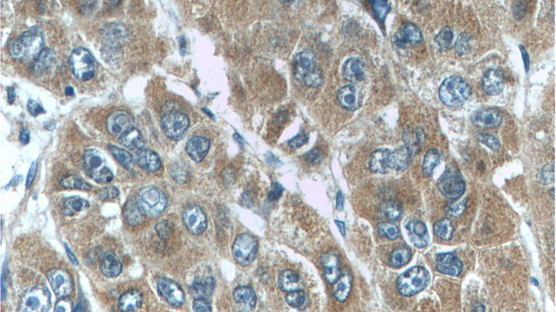 Immunohistochemistry of paraffin-embedded human liver cancer tissue slide using Catalog No:107744(ACOT12 Antibody) at dilution of 1:50 (under 40x lens)