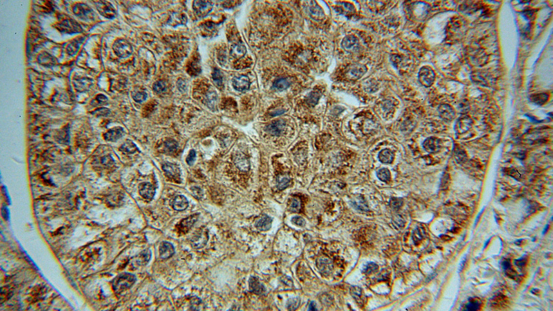 Immunohistochemical of paraffin-embedded human liver cancer using Catalog No:109817(D2HGDH antibody) at dilution of 1:50 (under 40x lens)