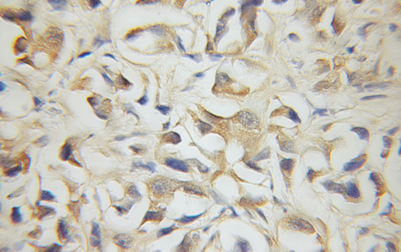 Immunohistochemical of paraffin-embedded human prostate cancer using Catalog No:109989(DLEU1 antibody) at dilution of 1:50 (under 40x lens)