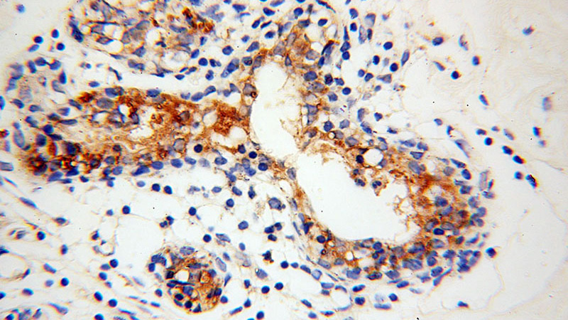 Immunohistochemical of paraffin-embedded human colon cancer using Catalog No:111317(GUSB antibody) at dilution of 1:50 (under 40x lens)