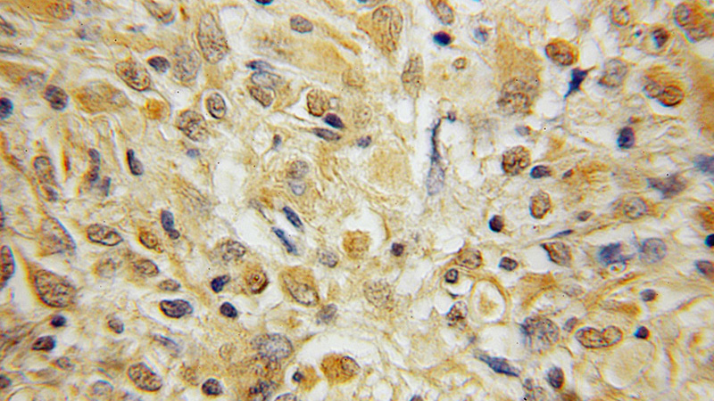 Immunohistochemical of paraffin-embedded human medulloblastoma using Catalog No:117134(BEX2 antibody) at dilution of 1:100 (under 10x lens)