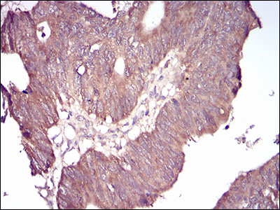 Immunohistochemical analysis of paraffin-embedded rectum cancer tissues using GSK3B mouse mAb with DAB staining.