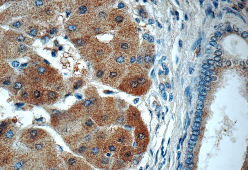 Immunohistochemistry of paraffin-embedded human hepatocirrhosis tissue slide using Catalog No:116587(USP11 Antibody) at dilution of 1:50 (under 40x lens)