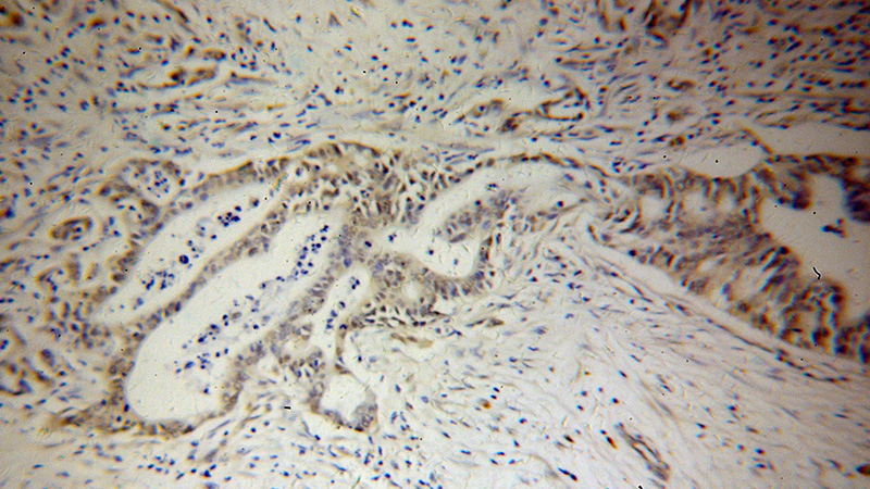 Immunohistochemical of paraffin-embedded human pancreas cancer using Catalog No:113594(PARP3 antibody) at dilution of 1:50 (under 10x lens)