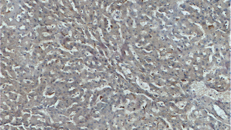 Immunohistochemistry of paraffin-embedded human liver tissue slide using (CD68 Antibody) at dilution of 1:200 (under 10x lens)