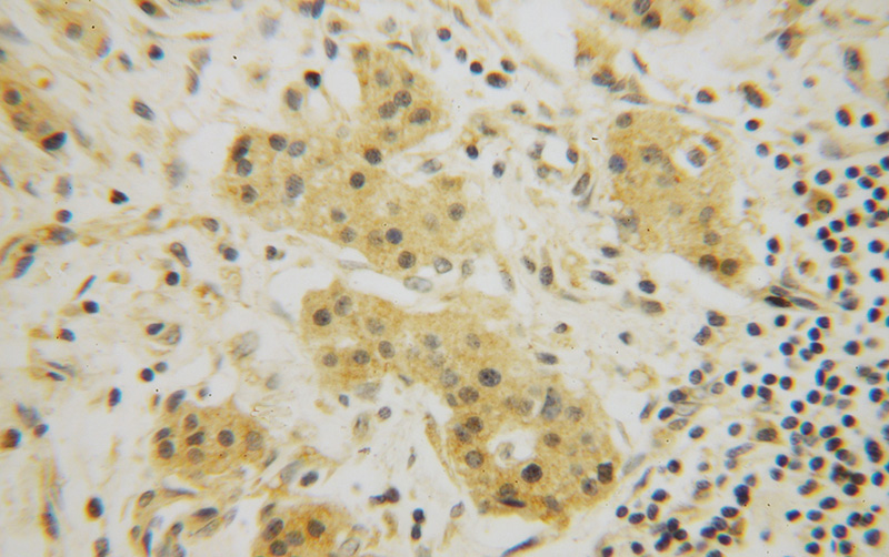 Immunohistochemical of paraffin-embedded human pancreas cancer using Catalog No:117115(BEGAIN antibody) at dilution of 1:50 (under 40x lens)