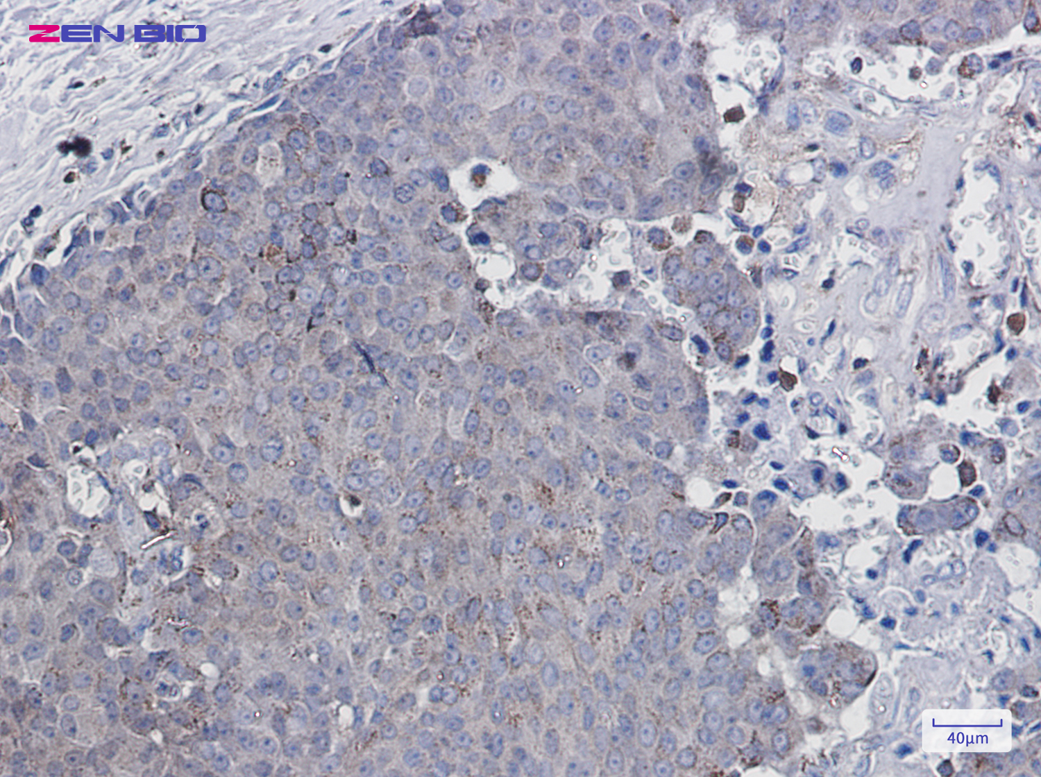 Immunohistochemistry of Adipose Triglyceride Lipase in paraffin-embedded Human breast cancer tissue using Adipose Triglyceride Lipase Rabbit pAb at dilution 1/100