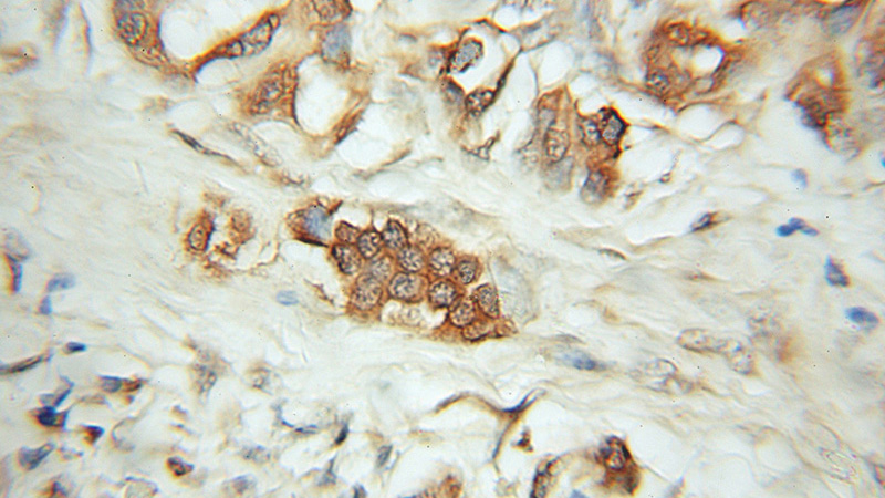 Immunohistochemical of paraffin-embedded human pancreas cancer using Catalog No:109060(CD164 antibody) at dilution of 1:50 (under 10x lens)