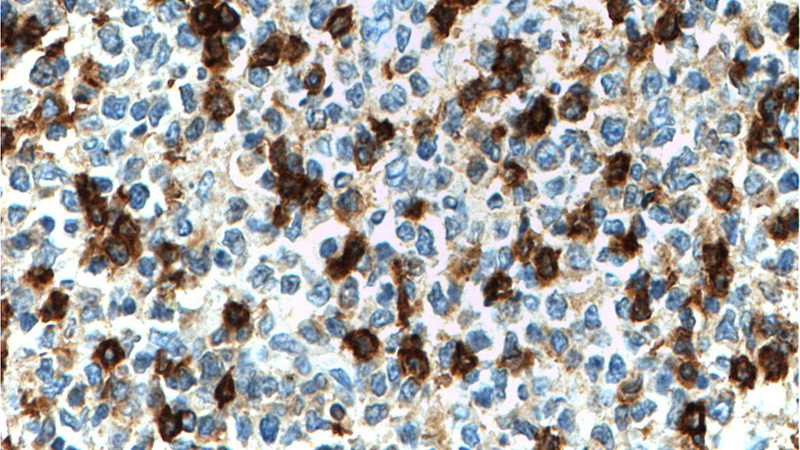 Immunohistochemistry of paraffin-embedded human tonsillitis tissue slide using Catalog No:109135(CD69 Antibody) at dilution of 1:200 (under 40x lens). heat mediated antigen retrieved with Tris-EDTA buffer(pH9).