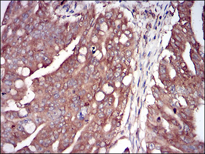 Immunohistochemical analysis of paraffin-embedded rectum cancer tissues using EIF2AK2 mouse mAb with DAB staining.