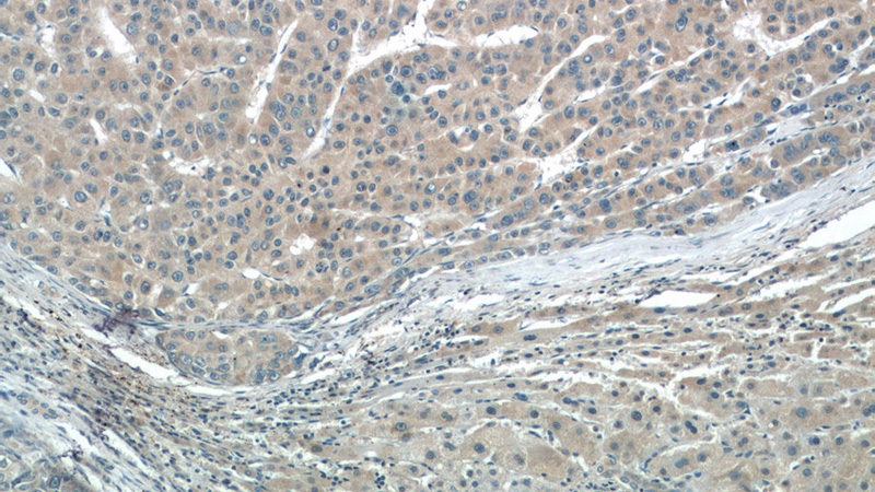 Immunohistochemistry of paraffin-embedded human liver cancer tissue slide using Catalog No:107061(APOA1 Antibody) at dilution of 1:50 (under 10x lens)
