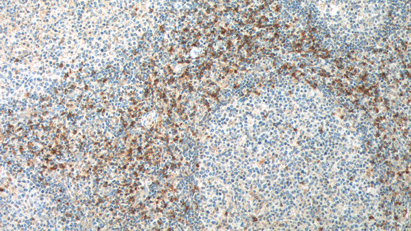 Immunohistochemistry of paraffin-embedded human tonsillitis tissue slide using Catalog No:109145(CD8A Antibody) at dilution of 1:200 (under 10x lens). heat mediated antigen retrieved with Tris-EDTA buffer(pH9).