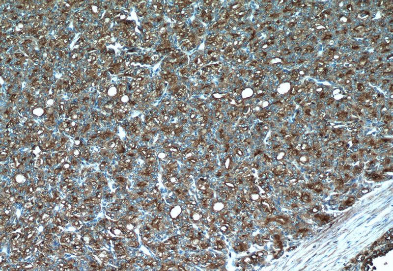 Immunohistochemistry of paraffin-embedded human prostate cancer tissue slide using Catalog No:107739(ACPP Antibody) at dilution of 1:50 (under 10x lens)